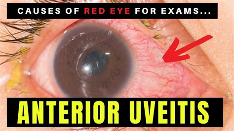 Uveitis Anterior