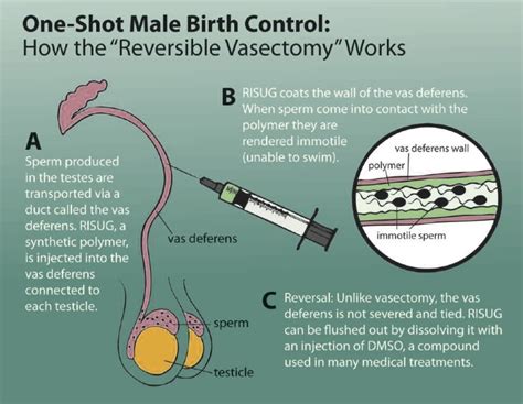 Reversible-Vasectomy - The Tenpenny Report