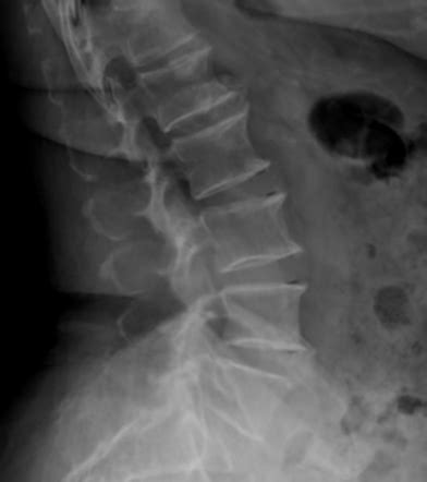 Intervertebral disc vacuum phenomenon | Radiology Reference Article | Radiopaedia.org