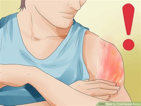 How to Treat Carpet Burns (with Pictures) - wikiHow