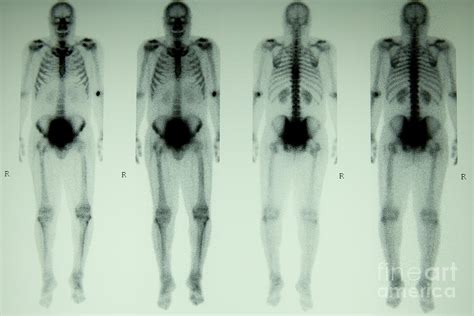 Nuclear Bone Scan Photograph by Inga Spence - Pixels