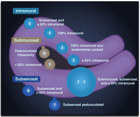 Intramural Fibroid Ultrasound