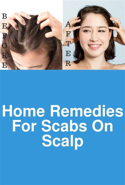 Home Remedies For Scabs On Scalp My friend, if you are suffering from ...