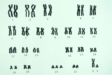 9 Rares trisomies génétiques au-delà du syndrome de Down