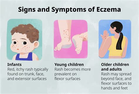 What Is Eczema Causes Signs And Symptoms Diagnosis And Treatment – NBKomputer