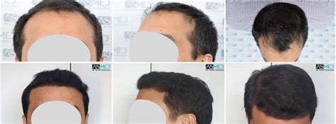 Norwood 4 Hair Transplantation Results | Asmed Hair Transplant