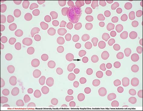 Hereditary Spherocytosis Blood Smear