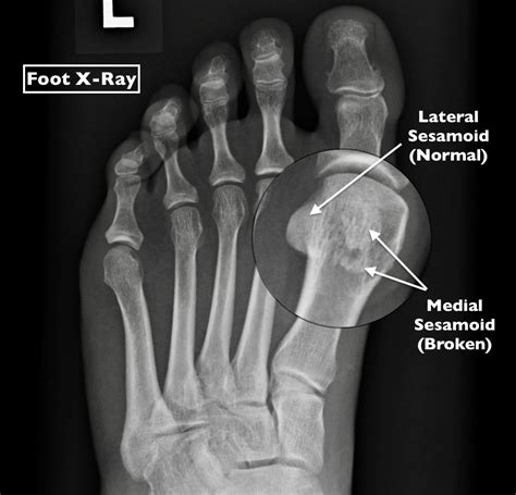 Could Your Nagging Foot Pain Be Sesamoiditis?