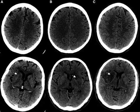 Challenging the Ischemic Core Concept in Acute Ischemic Stroke Imaging ...