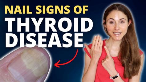 What Your Nails Say About Your Thyroid - YouTube