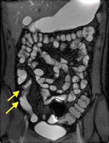 What are the benefits of MR Enterography performed at DIS? - Capitol ...