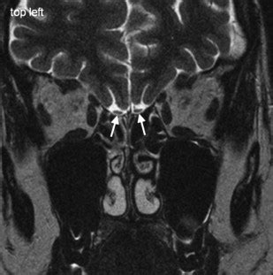 Pathology of the Olfactory Nerve | Radiology Key