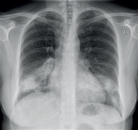 Chest X Ray Infiltrates