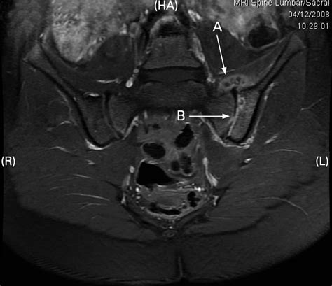 Sacroiliac Joint Dysfunction Mri