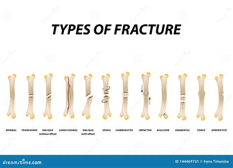 Types of Fracture. Fracture Bone Set. Infographics. Vector Illustration on Isolated Background ...