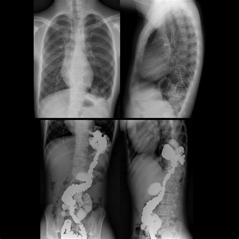 Teenager without symptoms after a large left congenital diaphragmatic ...