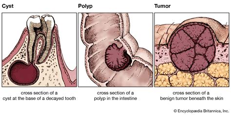 cyst, polyp, and tumor - Students | Britannica Kids | Homework Help