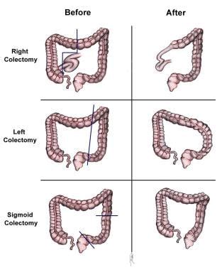 Colon Cancer Treatment & Management: Approach Considerations, Surgical Care, Ablation