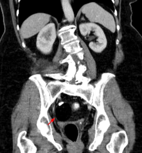 Benign Neoplasms — Teratoma | Online Medical Library