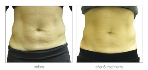 What is Body Contouring with Venus Freeze? - Buffalo Aesthetics