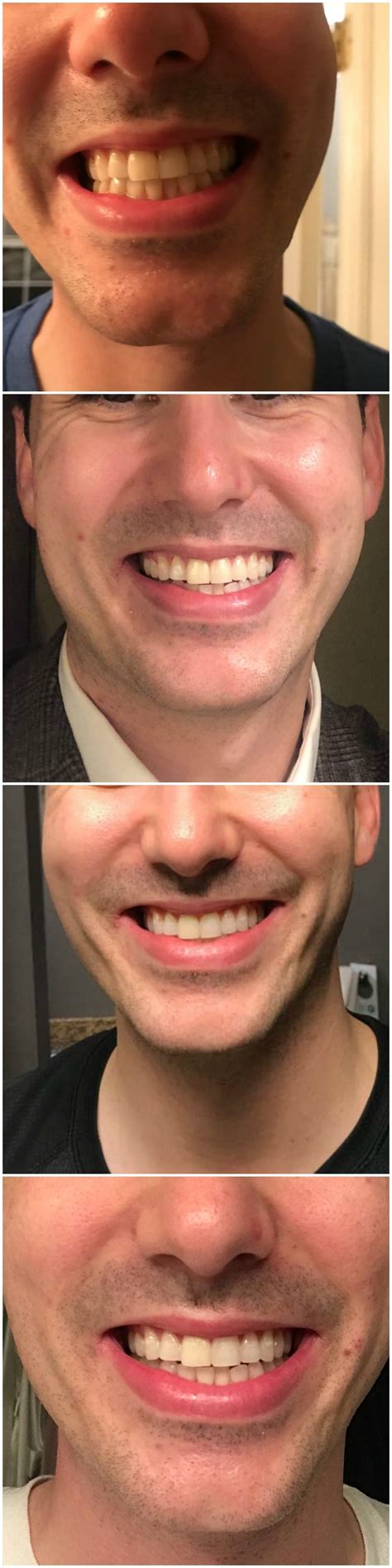 I wore Crest Whitestrips for 14 Days and here's what happened.