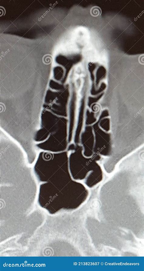 CT Scan of the Ethmoid Sinus Air Cells Stock Image - Image of ...