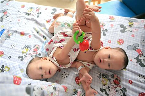 Conjoined twins to be separated- China.org.cn