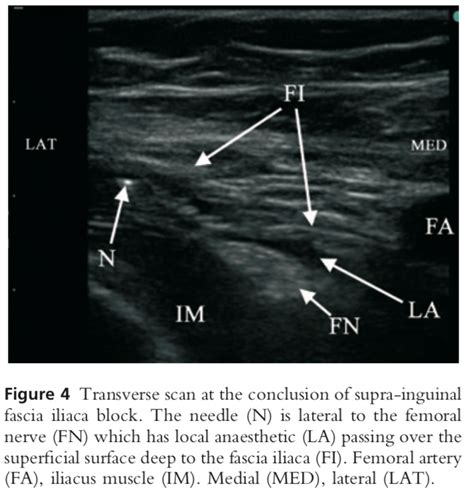 Ultrasound-guided supra-inguinal fascia iliaca block: a cadaveric evaluation of a novel approach ...