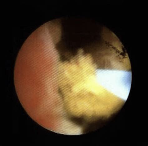 Flexible cystoscopy. | Download Scientific Diagram