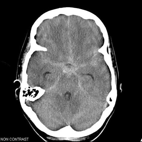 Subarachnoid Hemorrhage Mri