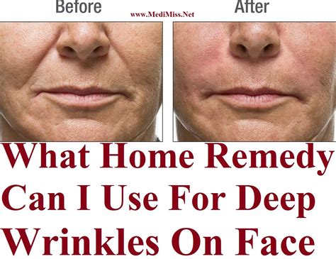 What Home Remedy Can I Use For Deep Wrinkles On Face | Face wrinkles, Home remedies beauty, Deep ...