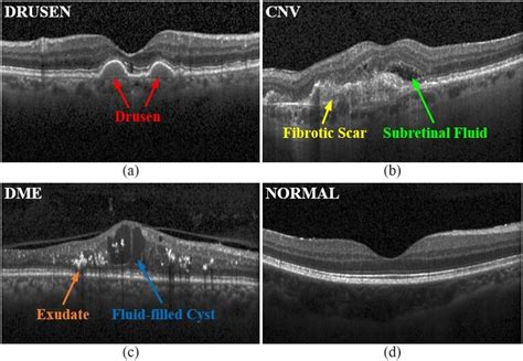 SD-OCT B-Scans of the retina showing Drusen, CNV, DME and Normal... | Download Scientific Diagram