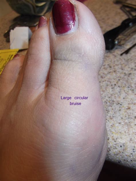 D & B DeWitt Family: Big Toe Bruise