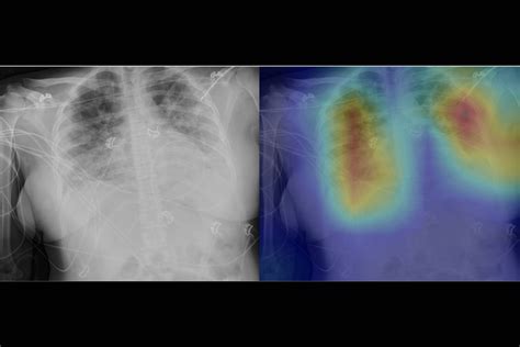 Radiologists use deep learning to find signs of COVID-19 in chest X-rays | Hub