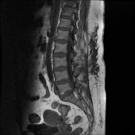 Paracentral lumbar disc extrusion | Image | Radiopaedia.org