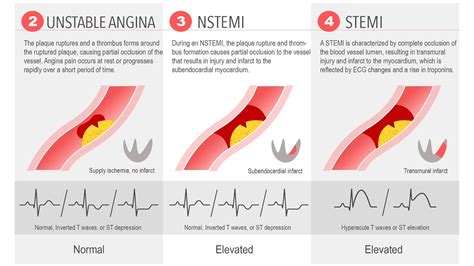 Acute Coronary Syndrome Sindrom Koroner Akut Unstable Angina, NSTEMI ...