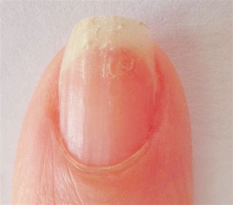 Brittle Nails: How to Strengthen Nails