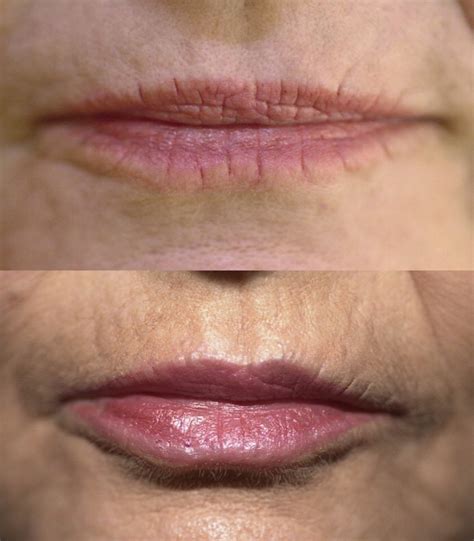 Lip Enhancement/ Wrinkles - Sadove Cosmetic Surgery