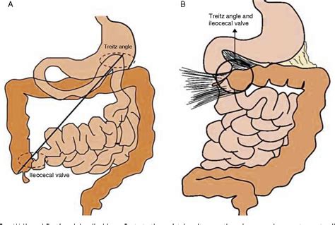 Figure 2 from Intestinal malrotation – volvulus: Imaging findings ...