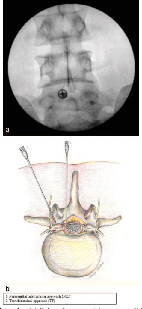 Parasagittal Meningioma | Semantic Scholar