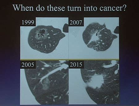 How CT Scans Reduce Lung Cancer Deaths | UCSF Radiology