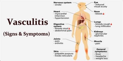 Vasculitis (Symptoms, Diagnosis, and Treatment) - Assignment Point