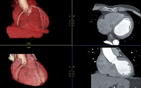 CT Coronary Angiogram — Dr Young Yu · Cardiologist · Sydney