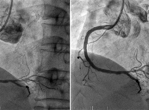 Invasive Coronary Angiography - Cos Cardio