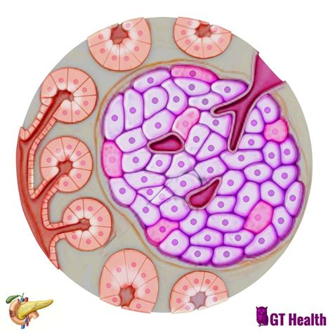 Islet cell transplantation in type 1 diabetes - GT health