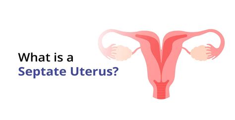 Septate Uterus (Uterine Septum): Symptoms Treatment, 54% OFF