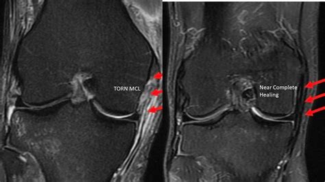 Knee Ligament Surgery: Is it Right for You? - CSC