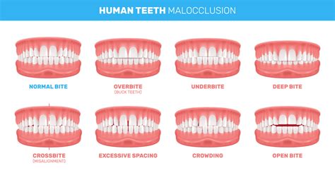 Understanding Malocclusions: Types, Effects, and Treatments