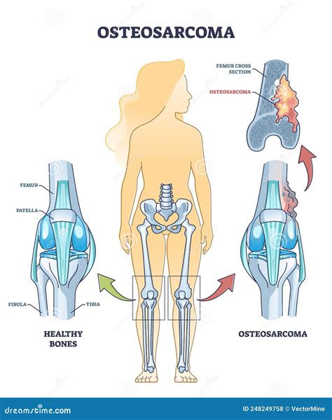 Osteosarcoma Bone Tumor As Osteogenic Sarcoma Skeleton Cancer Outline ...