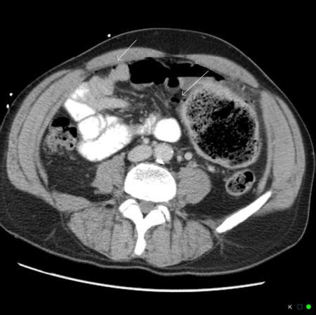 Stercoral colitis - WikEM